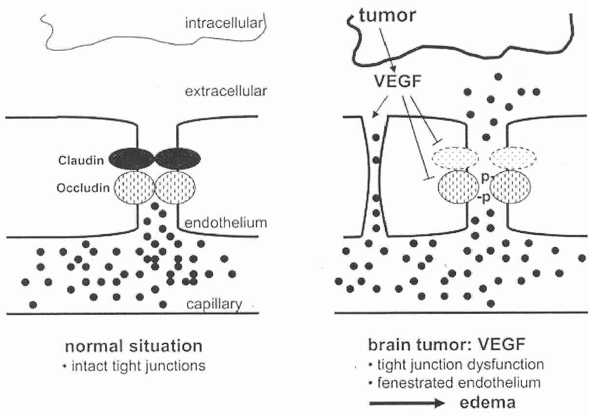 Tight junction, normal versus with glioma